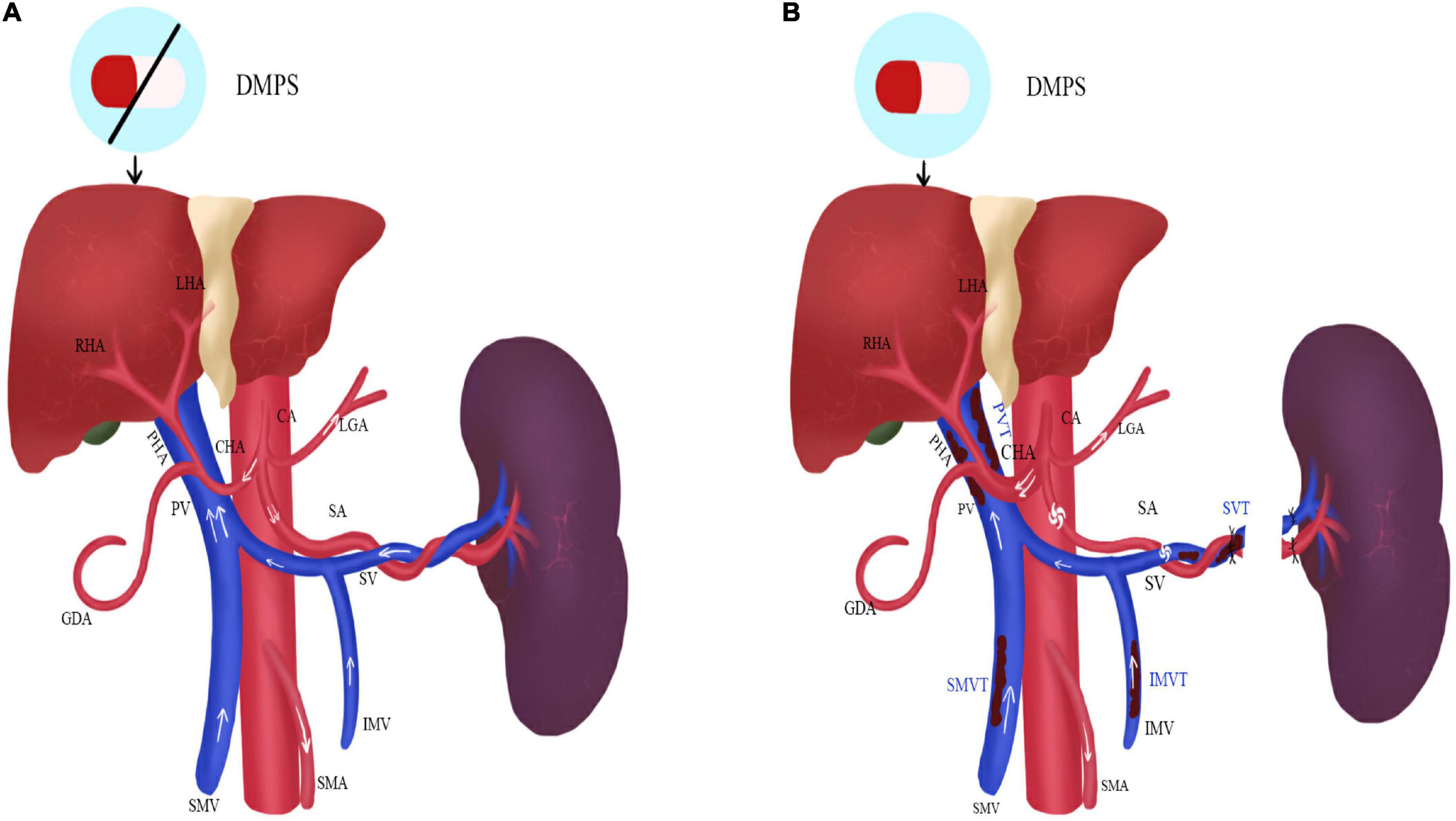 Frontiers Nomogram based prediction of portal vein system